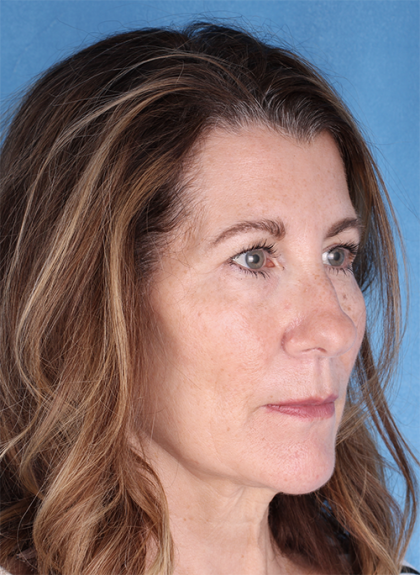 Lower Blepharoplasty Before & After Patient #525
