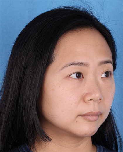 Lower Blepharoplasty Before & After Patient #524