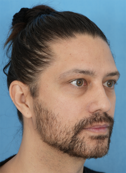 Lower Blepharoplasty Before & After Patient #527