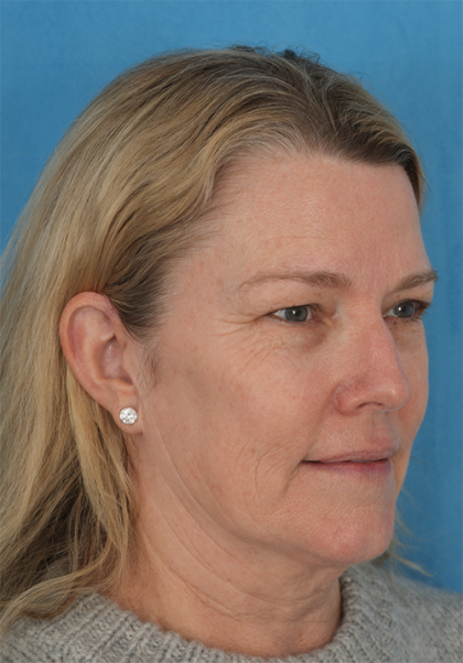 Four Lid Blepharoplasty Before & After Patient #394