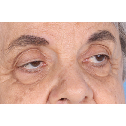 Ptosis Repair Before & After Patient #626