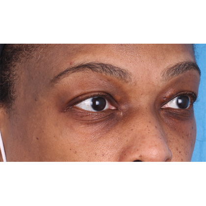 Upper Blepharoplasty Before & After Patient #693