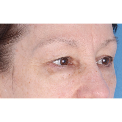 Upper Blepharoplasty Before & After Patient #695