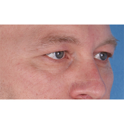 Upper Blepharoplasty Before & After Patient #697