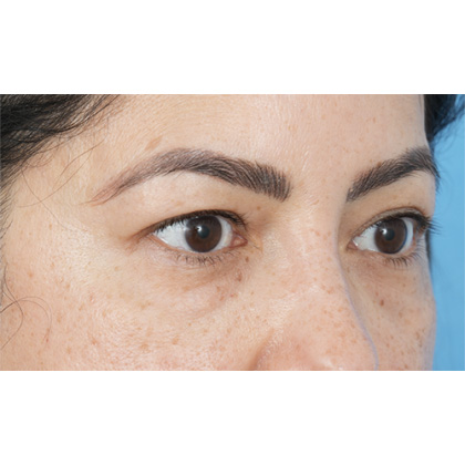 Four Lid Blepharoplasty Before & After Patient #397