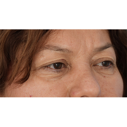 Upper Blepharoplasty Before & After Patient #701