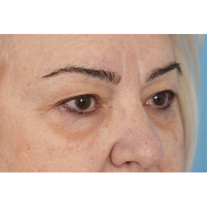 Upper Blepharoplasty Before & After Patient #702