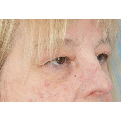 Upper Blepharoplasty Before & After Patient #728