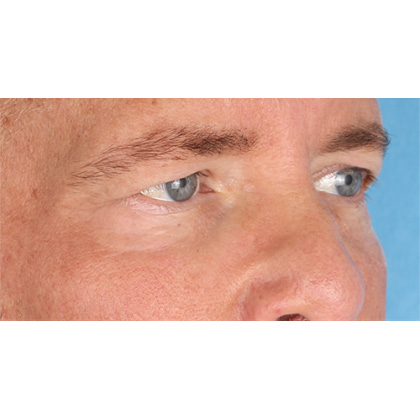 Upper Blepharoplasty Before & After Patient #699