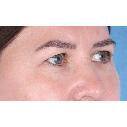 Upper Blepharoplasty Before & After Patient #698