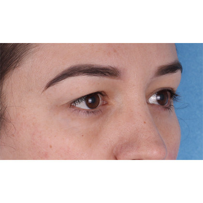 Upper Blepharoplasty Before & After Patient #700