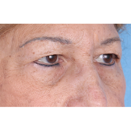 Upper Blepharoplasty Before & After Patient #814