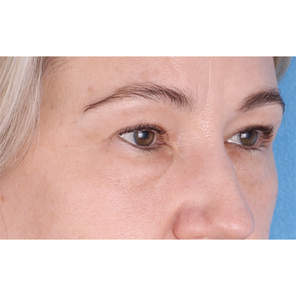 Four Lid Blepharoplasty Before & After Patient #399