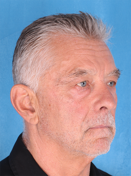 Four Lid Blepharoplasty Before & After Patient #396