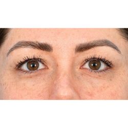 Upper Blepharoplasty Before & After Patient #703