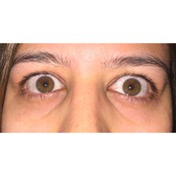 Retraction Repair Before & After Patient #827