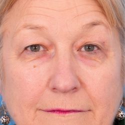 CO2 Laser Resurfacing Before & After Patient #392
