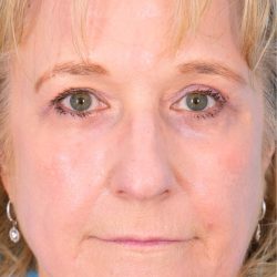 CO2 Laser Resurfacing Before & After Patient #392