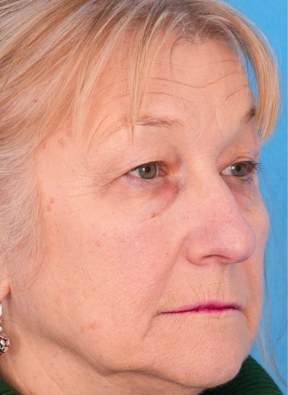 CO2 Laser Resurfacing Before & After Patient #392
