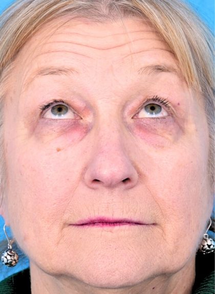 CO2 Laser Resurfacing Before & After Patient #392