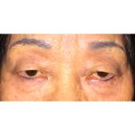 Double Eyelid Surgery Before & After Patient #341