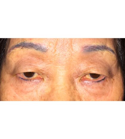 Double Eyelid Surgery Before & After Patient #341