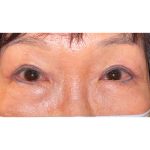 Double Eyelid Surgery Before & After Patient #342