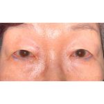 Double Eyelid Surgery Before & After Patient #342