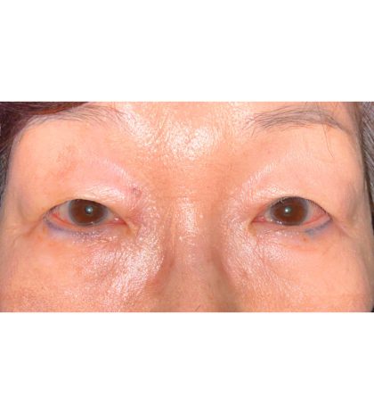 Double Eyelid Surgery Before & After Patient #342