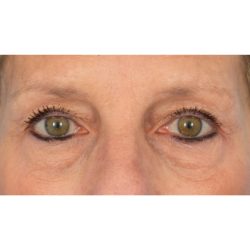 CO2 Laser Resurfacing Before & After Patient #400