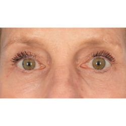 CO2 Laser Resurfacing Before & After Patient #400