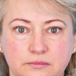 CO2 Laser Resurfacing Before & After Patient #393