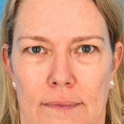 CO2 Laser Resurfacing Before & After Patient #394