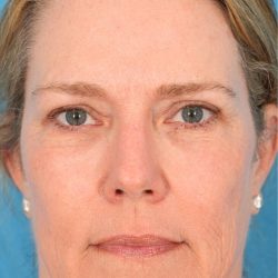 CO2 Laser Resurfacing Before & After Patient #394