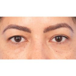 Quad Blepharoplasty Before & After Patient #397