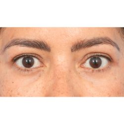 Quad Blepharoplasty Before & After Patient #397