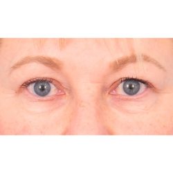 Quad Blepharoplasty Before & After Patient #416