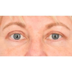 Quad Blepharoplasty Before & After Patient #416