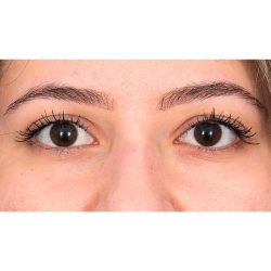 Lower Blepharoplasty Before & After Patient #520