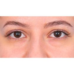 Lower Blepharoplasty Before & After Patient #520