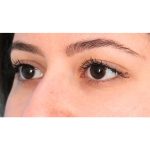 Lower Blepharoplasty Before & After Patient #520