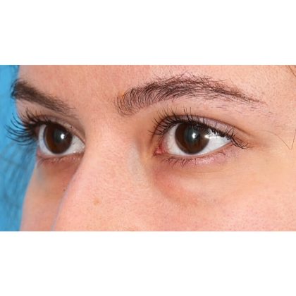 Lower Blepharoplasty Before & After Patient #520