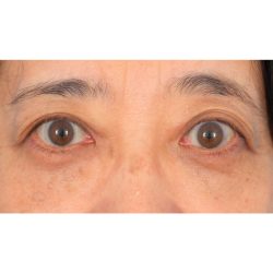Lower Blepharoplasty Before & After Patient #521