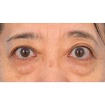 Lower Blepharoplasty Before & After Patient #521