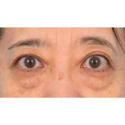 Lower Blepharoplasty Before & After Patient #521