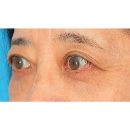 Lower Blepharoplasty Before & After Patient #521