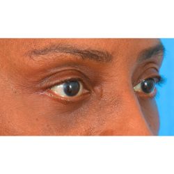 Lower Blepharoplasty Before & After Patient #522