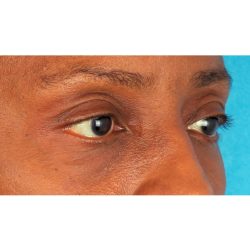 Lower Blepharoplasty Before & After Patient #522