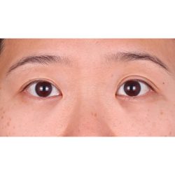 Lower Blepharoplasty Before & After Patient #524