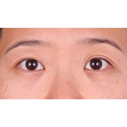 Lower Blepharoplasty Before & After Patient #524